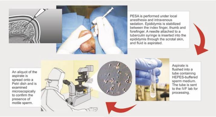 Testicular Biopsy: A Key Procedure for Male Infertility Diagnosis and Treatment