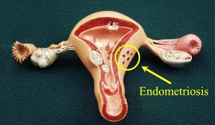 Endometriosis: Symptoms, Stages, Causes, and Treatment