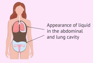 Ovarian Hyperstimulation Syndrome (OHSS)