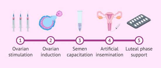 Artificial Insemination (IUI): A Simple and Effective Fertility Solution
