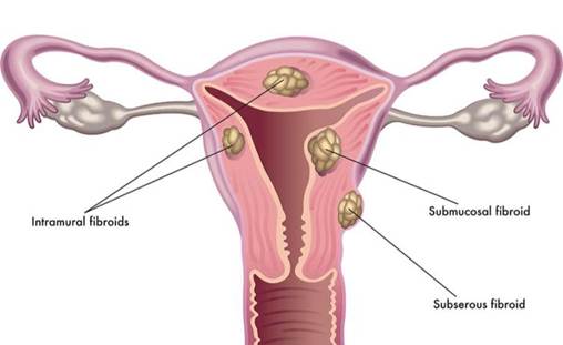 What Are Uterine Fibroids?